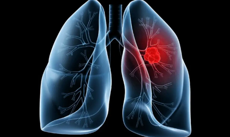 Saiba o que é adenocarcinoma pulmonar, câncer que atinge o Papa Leão